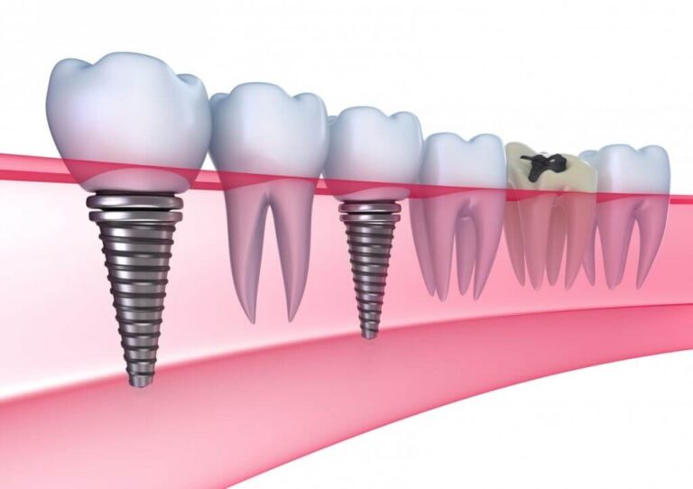 implant-dentar-arad